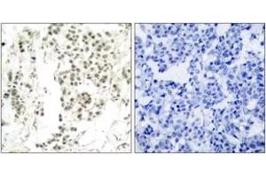Immunohistochemistry analysis of paraffin-embedded human breast carcinoma, using Chk1 (Phospho-Ser345) Antibody. (CHEK1 抗体  (pSer345))
