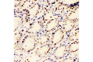 IHC analysis of EWSR1 using anti-EWSR1 antibody (ABIN3043825).