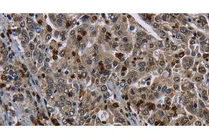 Immunohistochemistry of paraffin-embedded Human liver cancer tissue using CD42b Polyclonal Antibody at dilution 1:50 (CD42b 抗体)