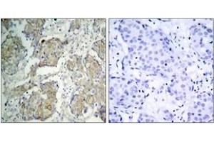 Immunohistochemistry analysis of paraffin-embedded human breast carcinoma, using VEGFR2 (Phospho-Tyr1214) Antibody. (VEGFR2/CD309 抗体  (pTyr1214))