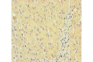 Immunohistochemistry of paraffin-embedded human liver cancer using ABIN7158295 at dilution of 1:100 (LAIR2 抗体  (AA 22-152))