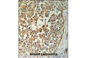 T Antibody (C-term) (ABIN653764 and ABIN2843060) IHC analysis in formalin fixed and paraffin embedded breast carcinoma followed by peroxidase conjugation of the secondary antibody and DAB staining. (STING/TMEM173 抗体  (C-Term))