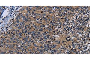 Immunohistochemistry of paraffin-embedded Human cervical cancer tissue using PCDHB15 Polyclonal Antibody at dilution 1:50 (PCDHB15 抗体)