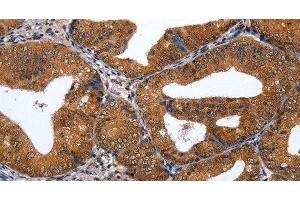Immunohistochemistry of paraffin-embedded Human cervical cancer tissue using GATA6 Polyclonal Antibody at dilution 1:35 (GATA6 抗体)