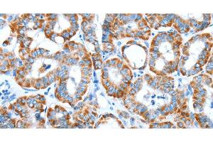 Immunohistochemistry of paraffin-embedded Human thyroid cancer tissue using ALDH5A1 Polyclonal Antibody at dilution 1:60 (ALDH5A1 抗体)
