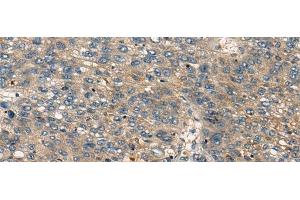Immunohistochemistry of paraffin-embedded Human liver cancer tissue using CDKL2 Polyclonal Antibody at dilution of 1:25(x200) (CDKL2 抗体)