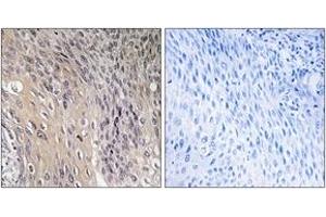 Immunohistochemistry analysis of paraffin-embedded human cervix carcinoma, using ARHGDIA (Phospho-Ser174) Antibody. (ARHGDIA 抗体  (pSer174))