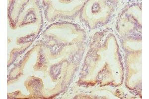 Immunohistochemistry of paraffin-embedded human prostate cancer using ABIN7145599 at dilution of 1:100 (Biliverdin Reductase 抗体  (AA 1-296))