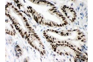 IHC-P: MSH2 antibody testing of human intestine cancer tissue (MSH2 抗体  (AA 337-583))