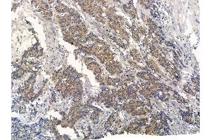 ABIN7094681 and ABIN7098732 at 1/100 staining human colorectal cancer by IHC-P.