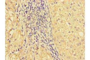 Immunohistochemistry of paraffin-embedded human liver cancer using ABIN7161686 at dilution of 1:100 (GBA2 抗体  (AA 656-867))