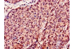 Immunohistochemistry of paraffin-embedded human ovarian cancer using ABIN7155434 at dilution of 1:100 (Histone H3.3 抗体  (AA 2-136))