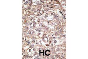 Formalin-fixed and paraffin-embedded human hepatocellular carcinoma tissue reacted with Tlr1 polyclonal antibody  , which was peroxidase-conjugated to the secondary antibody, followed by AEC staining. (TLR1 抗体  (C-Term))