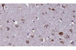 ABIN6274927 at 1/100 staining Human brain cancer tissue by IHC-P. (BCAS4 抗体)