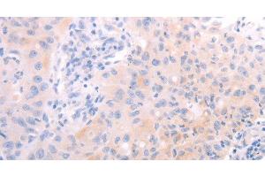 Immunohistochemistry of paraffin-embedded Human lung cancer tissue using AMH Polyclonal Antibody at dilution 1:30 (AMH 抗体)