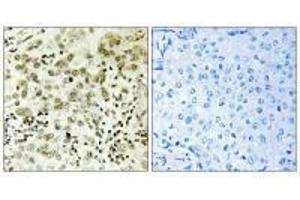 Immunohistochemistry analysis of paraffin-embedded human breast carcinoma tissue, using CTDSP1 antibody. (CTDSP1 抗体  (N-Term))