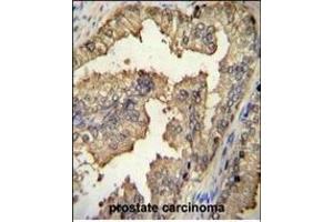 PRMT4 Antibody (Center) (ABIN655260 and ABIN2844856) immunohistochemistry analysis in formalin fixed and paraffin embedded human prostate carcinoma followed by peroxidase conjugation of the secondary antibody and DAB staining. (CARM1 抗体  (AA 346-377))