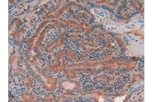 IHC-P analysis of Human Thyroid Cancer Tissue, with DAB staining. (TEK 抗体  (AA 1-116))