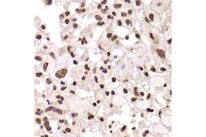Immunohistochemistry of paraffin-embedded human brain astrocytoma using XRCC6 Antibody.