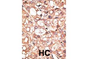 Formalin-fixed and paraffin-embedded human hepatocellular carcinoma tissue reacted with AOF2 polyclonal antibody , which was peroxidase-conjugated to the secondary antibody, followed by DAB staining. (LSD1 抗体  (Internal Region))
