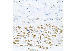 Immunohistochemistry of paraffin-embedded human lung cancer using DNMT1 antibody (ABIN7266810) at dilution of 1:100 (40x lens). (DNMT1 抗体  (AA 1-270))
