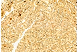 ABIN6257585 and ABIN6274582 at 1/100 staining Human lung cancer by IHC-P.