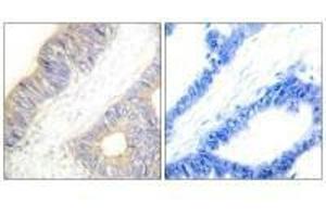 Immunohistochemistry analysis of paraffin-embedded human colon carcinoma tissue using Stefin A antibody. (CSTA 抗体  (C-Term))