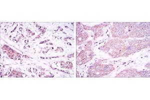 Immunohistochemical analysis of paraffin-embedded breast cancer tissues (left) and liver cancer tissues (right) using BECN1 mouse mAb with DAB staining. (Beclin 1 抗体)
