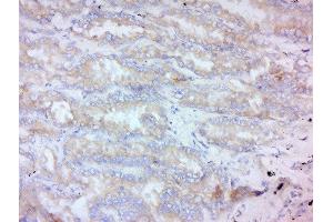 Formalin-fixed and paraffin embedded human lung carcinoma labeled with Anti-MMP-2 Polyclonal Antibody, Unconjugated  at 1:200 followed by conjugation to the secondary antibody and DAB staining. (MMP2 抗体  (AA 561-660))