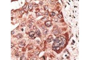 IHC analysis of FFPE human hepatocarcinoma tissue stained with the Recoverin antibody (Recoverin 抗体  (AA 169-200))