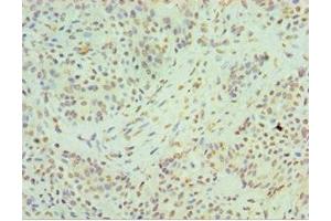 Immunohistochemistry of paraffin-embedded human breast cancer using ABIN7155133 at dilution of 1:100 (HNRNPM 抗体  (AA 491-730))