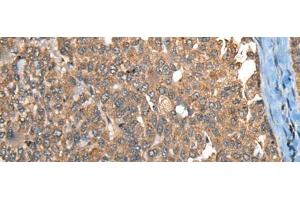 Immunohistochemistry of paraffin-embedded Human liver cancer tissue using C1R Polyclonal Antibody at dilution of 1:40(x200) (C1R 抗体)