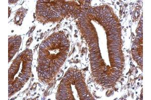IHC-P Image Immunohistochemical analysis of paraffin-embedded human colon carcinoma, using Vitronectin, antibody at 1:500 dilution. (Vitronectin 抗体)