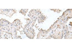 Immunohistochemistry of paraffin-embedded Human thyroid cancer tissue using LSM10 Polyclonal Antibody at dilution of 1:50(x200) (LSM10 抗体)
