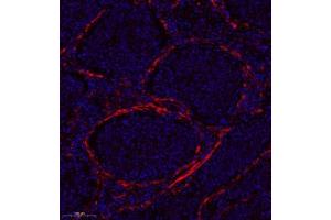 Immunofluorescence analysis of paraffin embedded human colon cancer using GDF5 (ABIN7074131) at dilution of 1: 200 (GDF5 抗体)