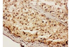 IHC testing of FFPE human liver cancer tissue with SIP antibody.