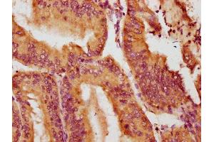 IHC image of ABIN7161004 diluted at 1:100 and staining in paraffin-embedded human endometrial cancer performed on a Leica BondTM system. (NOX1 抗体  (AA 418-564))