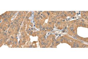 Immunohistochemistry of paraffin-embedded Human thyroid cancer tissue using BOLA1 Polyclonal Antibody at dilution of 1:35(x200) (BOLA1 抗体)