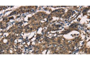 Immunohistochemistry of paraffin-embedded Human gastic cancer using SENP1 Polyclonal Antibody at dilution of 1:40 (SENP1 抗体)