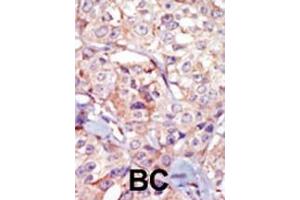 Formalin-fixed and paraffin-embedded human cancer tissue reacted with the primary antibody, which was peroxidase-conjugated to the secondary antibody, followed by AEC staining. (GSG2 抗体  (AA 323-352))