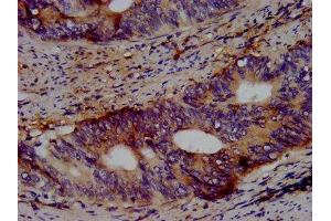 IHC image of ABIN7164019 diluted at 1:500 and staining in paraffin-embedded human colon cancer performed on a Leica BondTM system. (KCNV2 抗体  (AA 1-155))