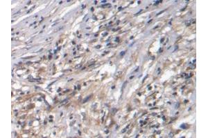 IHC-P analysis of Human Ovarian cancer Tissue, with DAB staining. (CTGF 抗体  (AA 80-200))