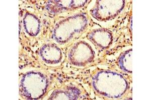 Immunohistochemistry of paraffin-embedded human gastric cancer using ABIN7157538 at dilution of 1:100 (KLRG1 抗体  (AA 60-195))