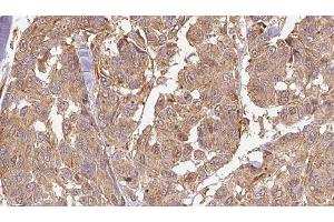 ABIN6278586 at 1/100 staining Human Melanoma tissue by IHC-P. (KLHL3 抗体  (N-Term))