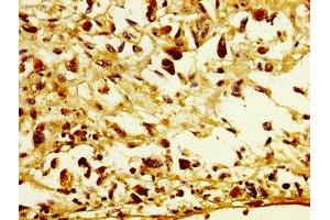 IHC image of ABIN7153729 diluted at 1:300 and staining in paraffin-embedded human melanoma performed on a Leica BondTM system. (POFUT2 抗体  (AA 125-271))