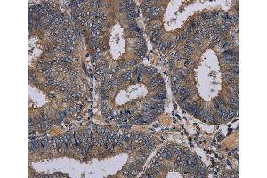 Immunohistochemistry of Human esophagus cancer using PVRL3 Polyclonal Antibody at dilution of 1:40 (nectin-3 抗体)