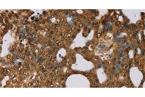 Immunohistochemistry of paraffin-embedded Human cervical cancer using PSMC2 Polyclonal Antibody at dilution of 1:30 (PSMC2 抗体)