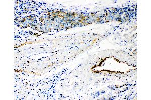 Anti-HYAL3 antibody, IHC(P) IHC(P): Human Mammary Cancer Tissue (HYAL3 抗体  (C-Term))