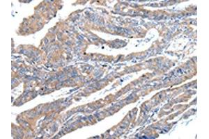 The image on the left is immunohistochemistry of paraffin-embedded Human esophagus cancer tissue using ABIN7193094(ZFAND2A Antibody) at dilution 1/30, on the right is treated with synthetic peptide. (ZFAND2A 抗体)