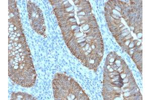 Formalin-fixed, paraffin-embedded human Colon Carcinoma stained with EpCAM Rabbit Recombinant Monoclonal Antibody (EGP40/2571R). (Recombinant EpCAM 抗体  (Extracellular Domain))